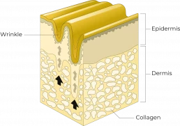 Wrinkle formation due to a lack of collagen in the dermis skin layer.